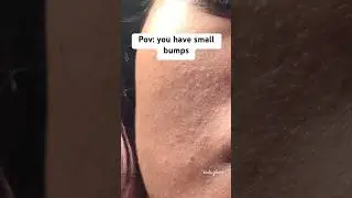 Best cream for textured skin and small bumps | Aziderm 20 Azelaic Cream #acne #skincare #fyp