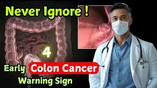 Don't Make the Same Mistake I Did! 4 Early Colon Cancer Warning Signs