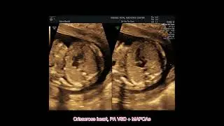 19w crisscross heart, PA VSD + MAPCAs, bệnh tim bẩm sinh 19 tuần