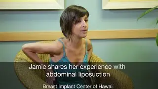 Abdominal Liposuction Review from Kona Patient - Dr. S. Larry Schlesinger