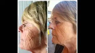 Nerium Before & After