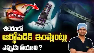 When Should Orthopedic Implants Be Removed? | Dr. Sharath Babu