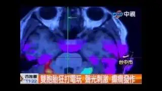 雙胞胎狂打電玩 聲光刺激 癲癇發作