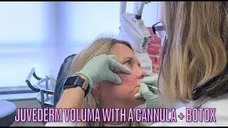 Non-Surgical Facial Rejuvenation with Juvederm Voluma & Botox