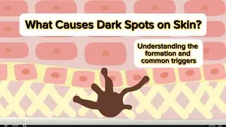 What Causes Dark Spots on Skin? Understanding the Formation and Common Triggers