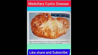 Medullary Cystic Disease-Image of the day |Target NEXT NEETPG FMGE INICET| AP Singh #shorts #shorts
