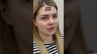 Nose reconstruction after failed surgery! Premium Studio Istanbul