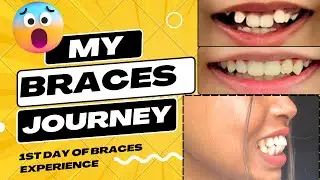 MY BRACES JOURNEY| ITNA LATE BRACES LGA MERA 🥹🙀 | WHY ?🙀 #metalbraces #braces treatment #dentist