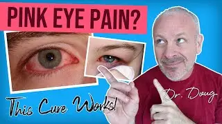 👁 PINK EYE 👁 CURE!  | Dr. Doug