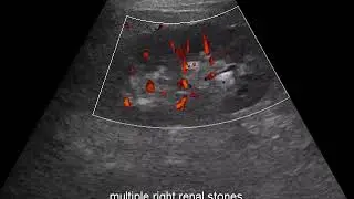 case 579 multiple right renal stone gain test