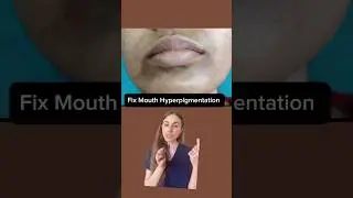 Remove Dark Patches Around Your Mouth Forever #dermatologist