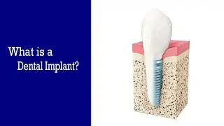 What Is A Dental Implant | Dental Implant Information