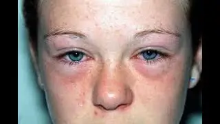 Yoga : Hayfever / 360 Nava Yogi Science / DR. A.S. SELVAM