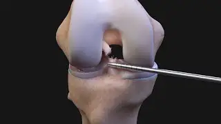 ACL Reconstruction FAQs ACLTear.com