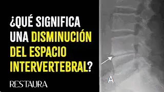 &iquest;Qu&eacute; significa una disminuci&oacute;n del espacio intervertebral?