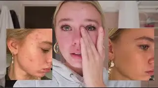 FRA AKNE TIL REN HUD