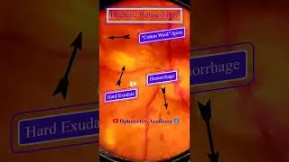 Diabetic retinopathy | Hemorrhages | cotton wool spots | Hard exudates | Fundus | Short Video 125