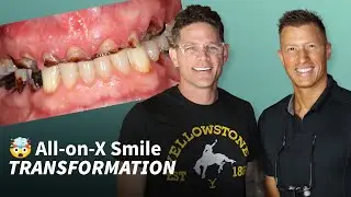 Discover the Life-Changing Power of All on 4 Dental Implants