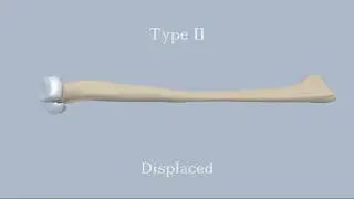 Mason Classification of Radial Head Fractures