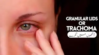 The BEST Treatment of Granular Lids or Trachoma | Homeopathic Medicine | By Dr. Ataullah