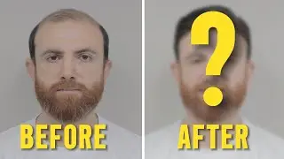 PROTEZ SA&Ccedil; İLE GEN&Ccedil; KAL - Hair Replacement