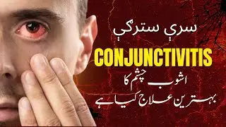 Conjunctivitis