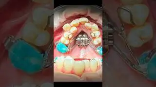 Аппарат для быстрого расширения верхней челюсти #стоматология  #брекеты #mse
