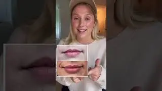 Lip Filler Transformation: Before & After Journey at The Luxe Room | Denver & Boulder, Colorado
