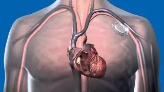 What Is a Pacemaker and How Does It Work