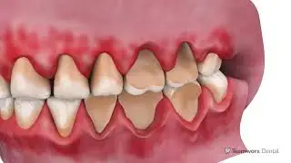 Navigating Nightguard Care and Lower Teeth Preservation