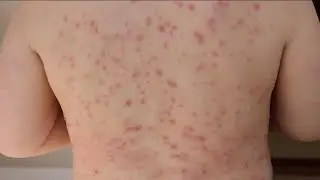 Measles case connected to Springfield-Branson National Airport
