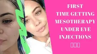 Mesotherapy Rejuvenation Injections VLOG  | Treating Dark Circles And Eye Bags - 2019
