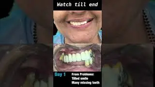 Smile makeover | Full Mouth Rehabilitation | Best Dentist India