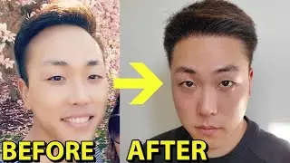 MOTION CLINIC'S BIGGEST HAIR TRANSPLANT PROMO OF THE YEAR! **ENDING SOON**