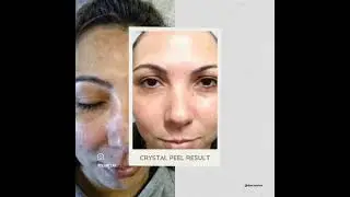 Dermelar Crystal Peel treatment