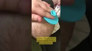 Baby hack for dandruff! #shorts #baby #parenting #babyhack Was informed, may not be 4 all hair types
