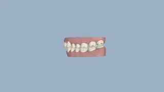 Invisalign Clin Check Left Profile