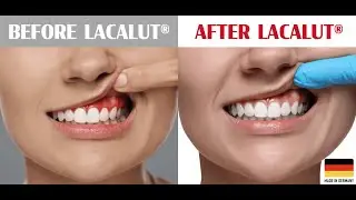 How Does LACALUT&reg; Toothpaste Work to Treat and Repair Bleeding Gums, Gingivitis & Periodontitis?