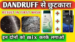 Treatment of Dandruff | How to cure dandruff | #Dandruff #hair