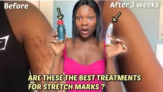 The best stretch mark Treatment ever! | Best topical stretch mark treatment #tretinoin #stretchmarks