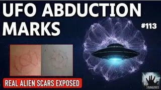 #113 MUFON Investigates UFO Abduction with Physical Marks?