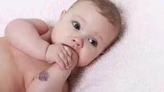 What is a hemangioma? Nemours KidsHealth