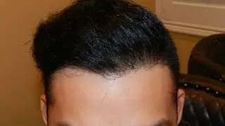 Asian Lower Hairline by FUE method by Dr. Diep in San Francisco, CA  