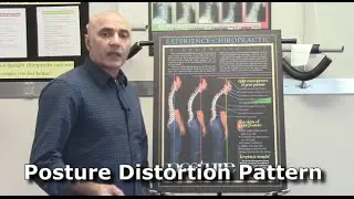 Posture Distortion Patterns | Burlington Ontario