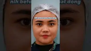 FILLER HIDUNG #youtubeshorts #shortsvideo #youtube #kecantikanwajah #fypシ #fyp