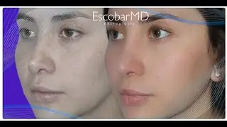 Before After |Revision Rhinoplasty | Scarless Nose Job in a Thin-Skinned Patient | Dr Escobar| Dubai