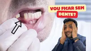 FIZ UM IMPLANTE, VOU SAIR SEM DENTE?