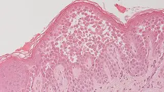 Quiz 12 - Skin Pathology