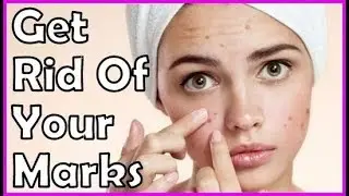 Top 3 Efficient Ways To Get Rid Of Scars And Marks On Your Face | TSC inStyle