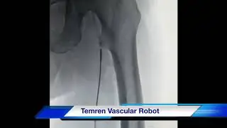 TemREN&reg; Atherectomy System for Robotic Plaque Removal in Peripheral Artery Disease | INVAMED